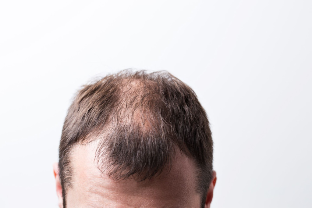 Regain Confidence with Expert Hairline Restoration in Australia