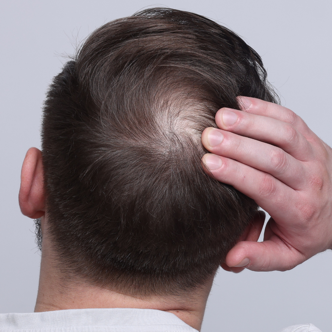 Hair Restoration Surgery: What to Know About Hairline Restoration
