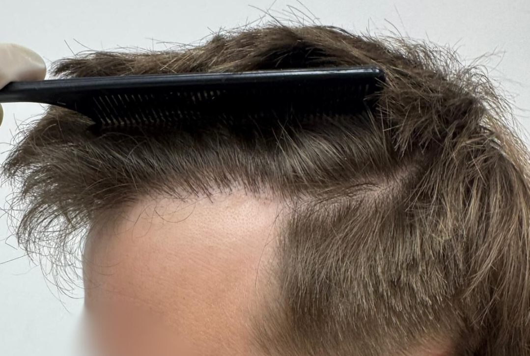 How Does Hair Transplant Work?
