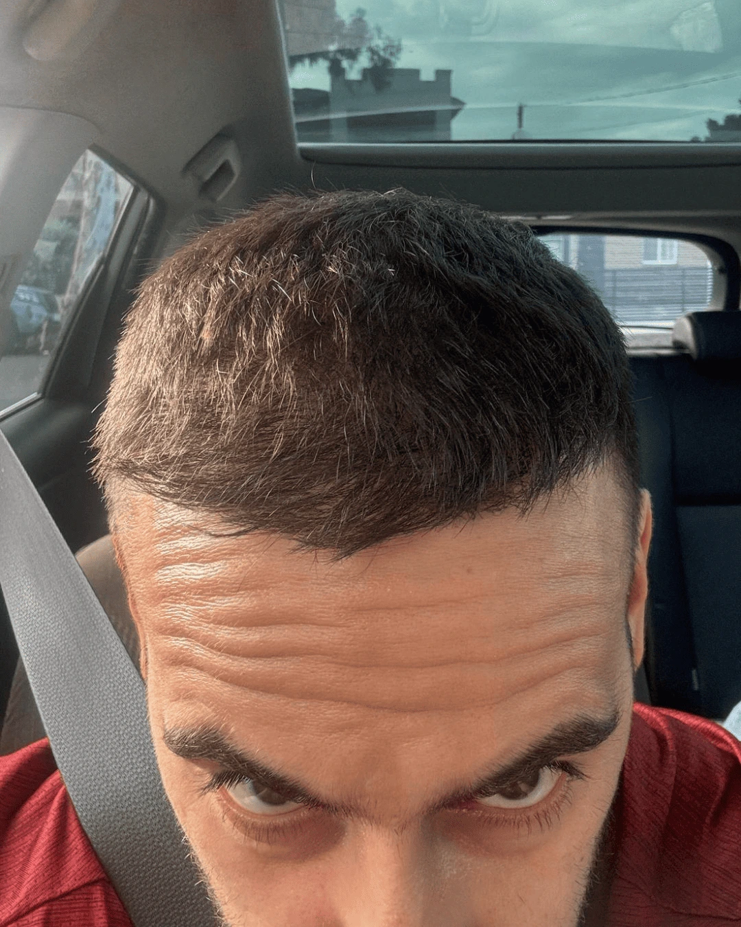 hair translpant after-10