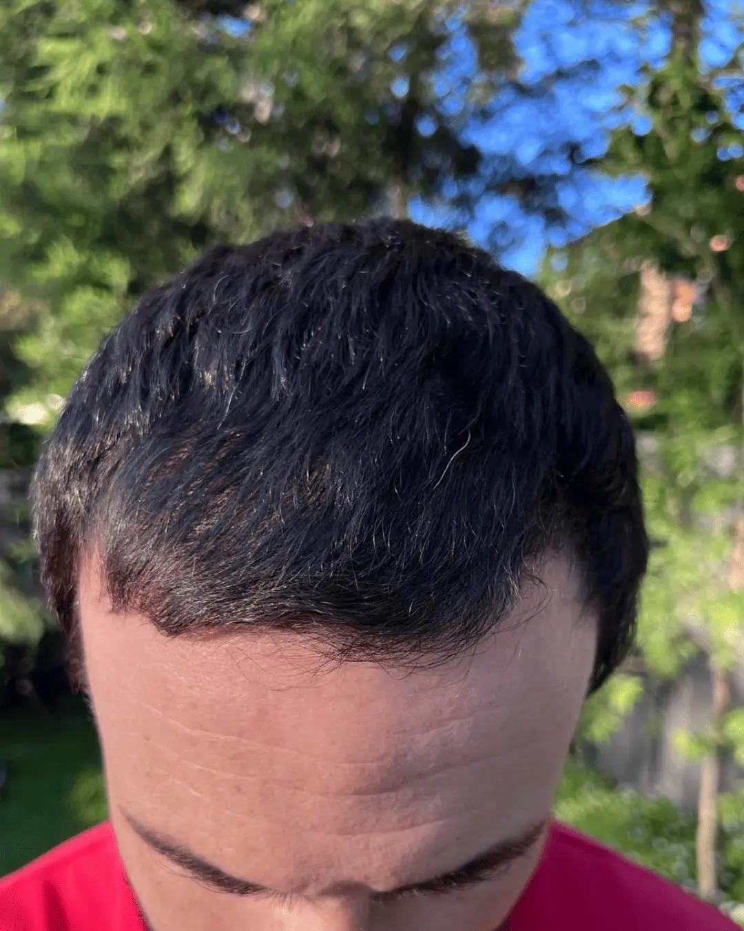 hair translpant after-2