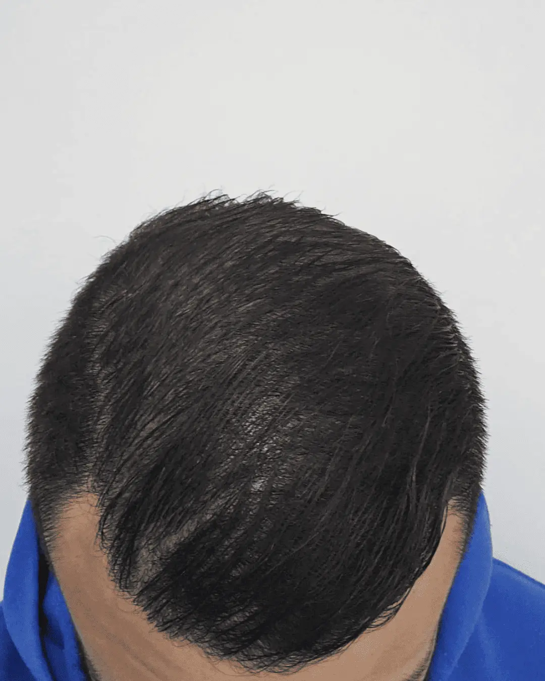 hair translpant after-3