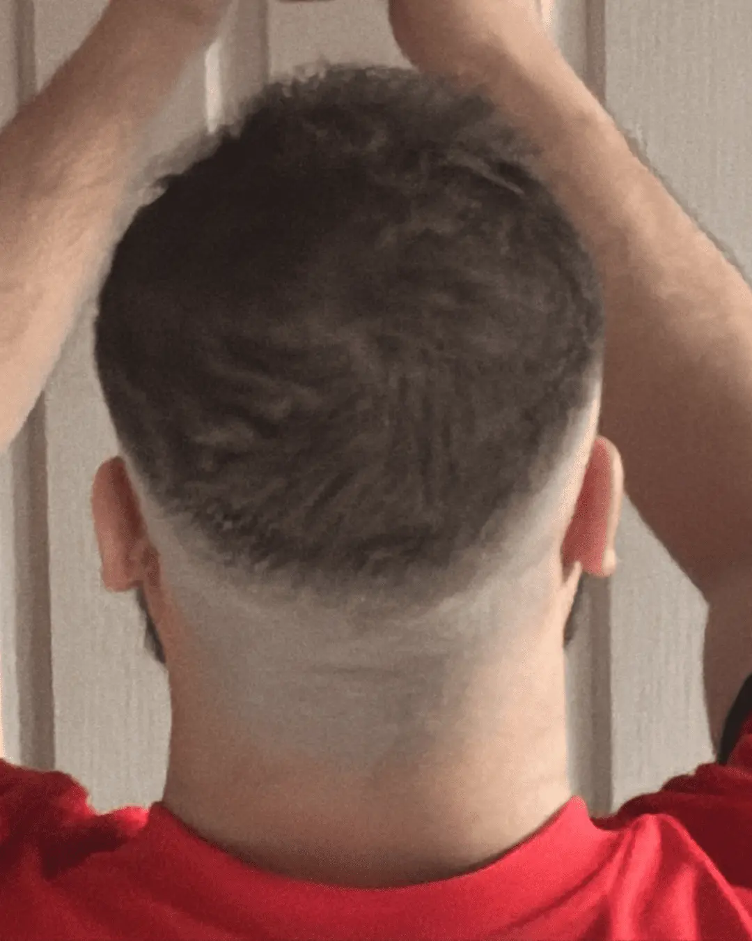 hair translpant after-4