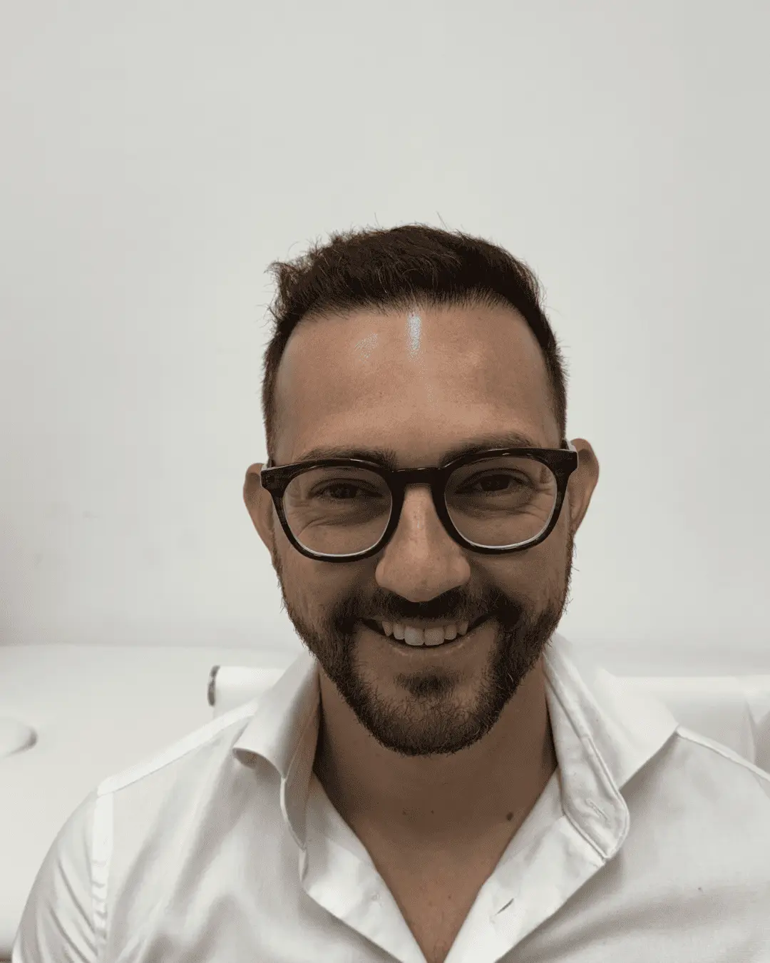 hair translpant after-5