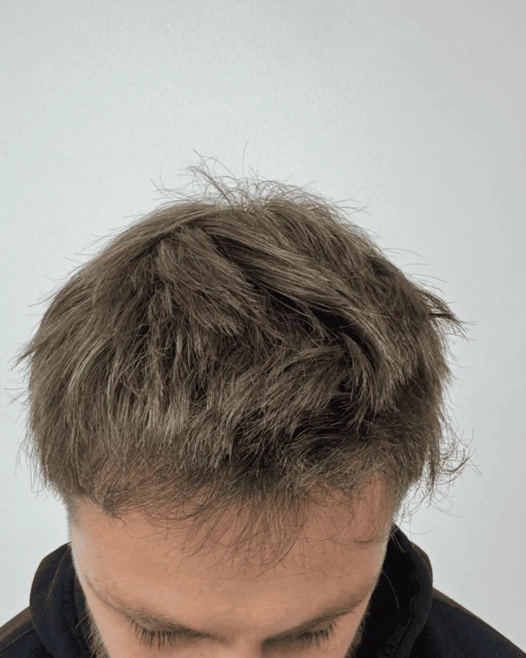 hair translpant after-6