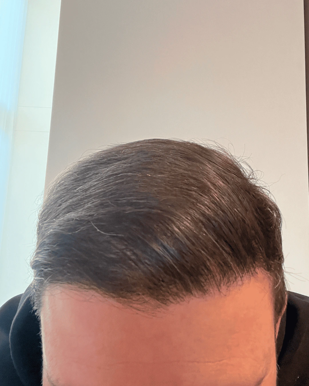 hair translpant after-7