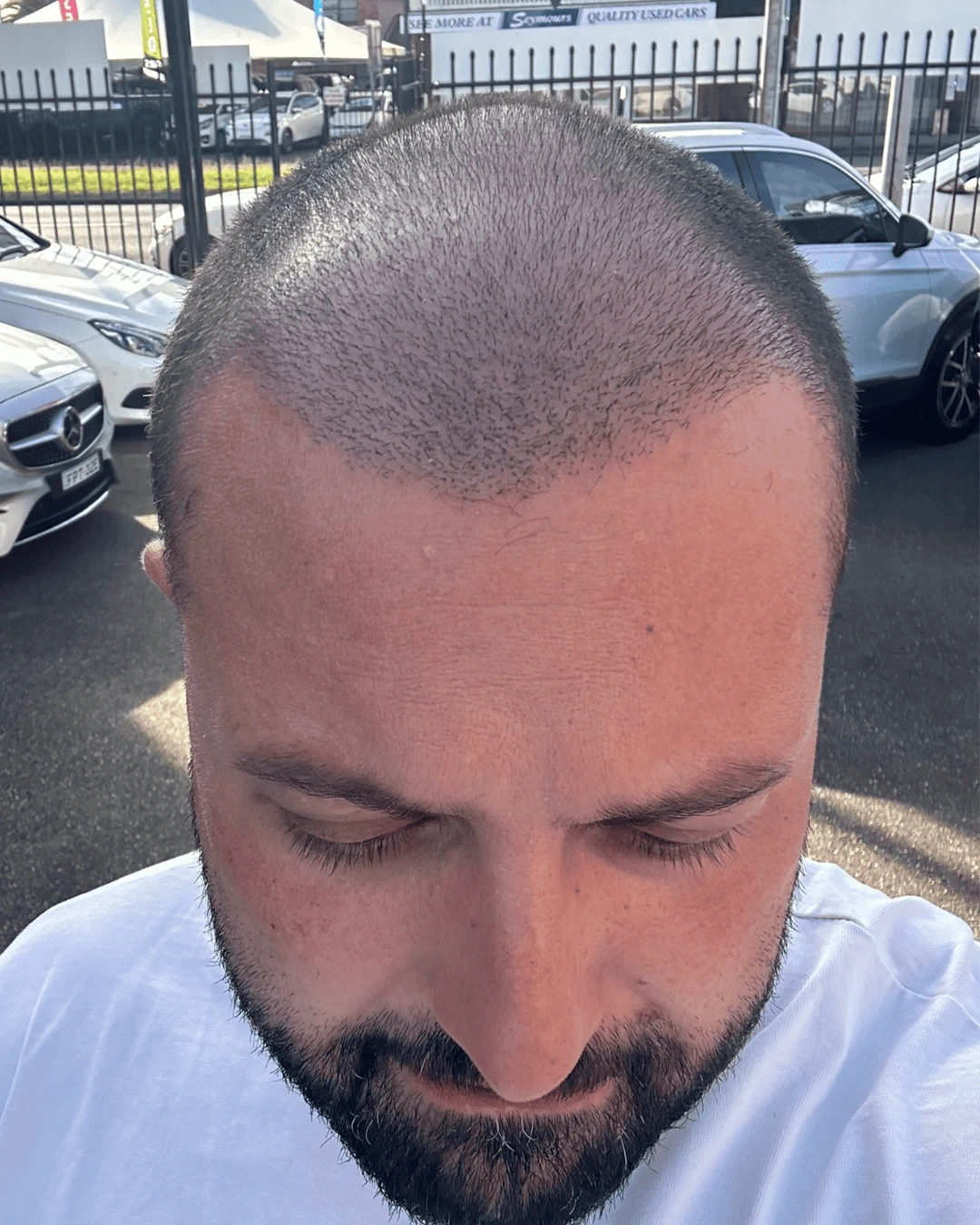 hair translpant after-8