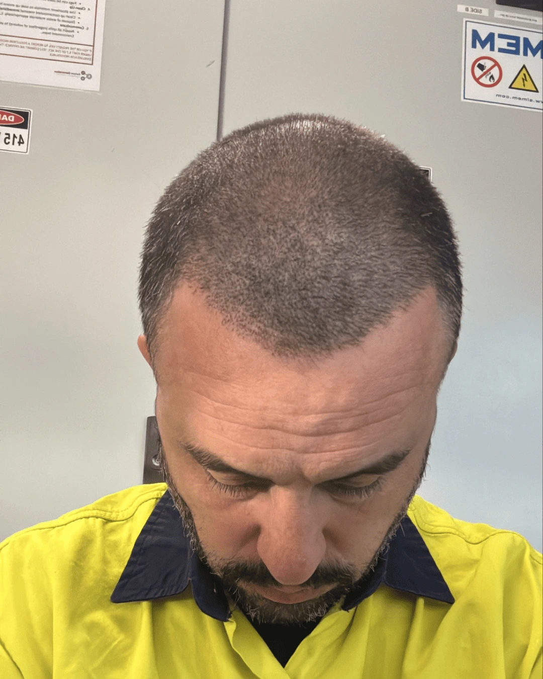 hair translpant after-9