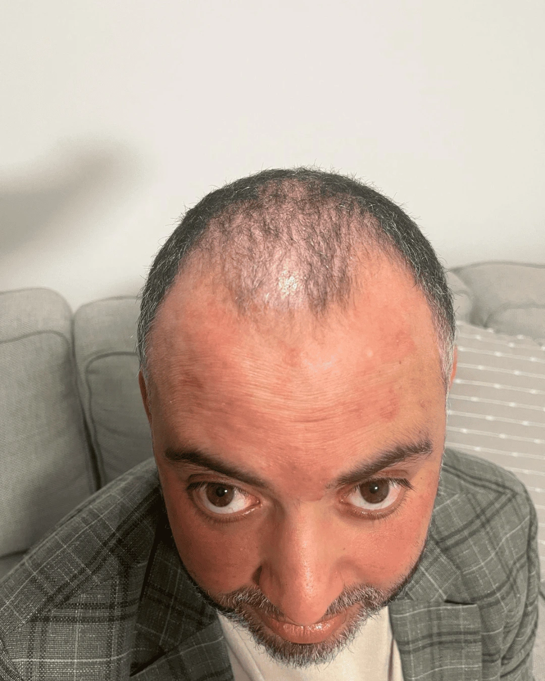 hair translpant before-1