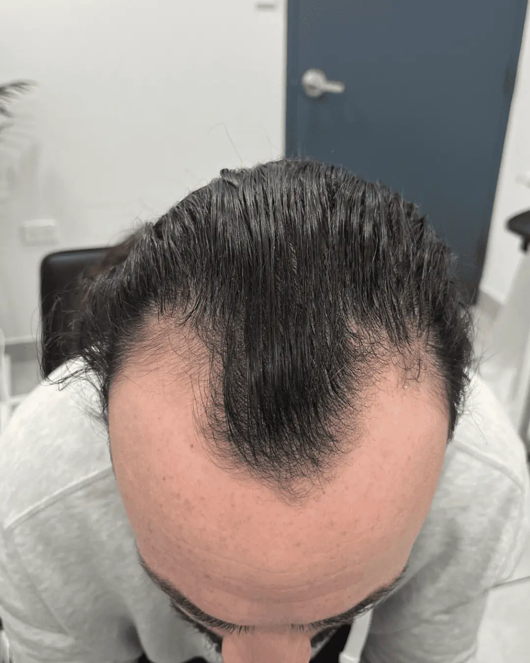 hair translpant before-2