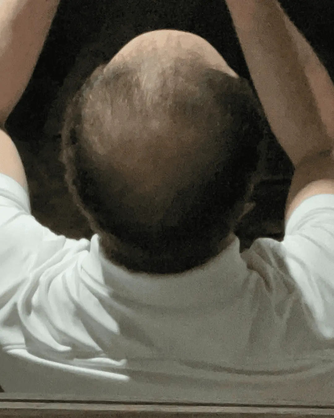 hair translpant before-4