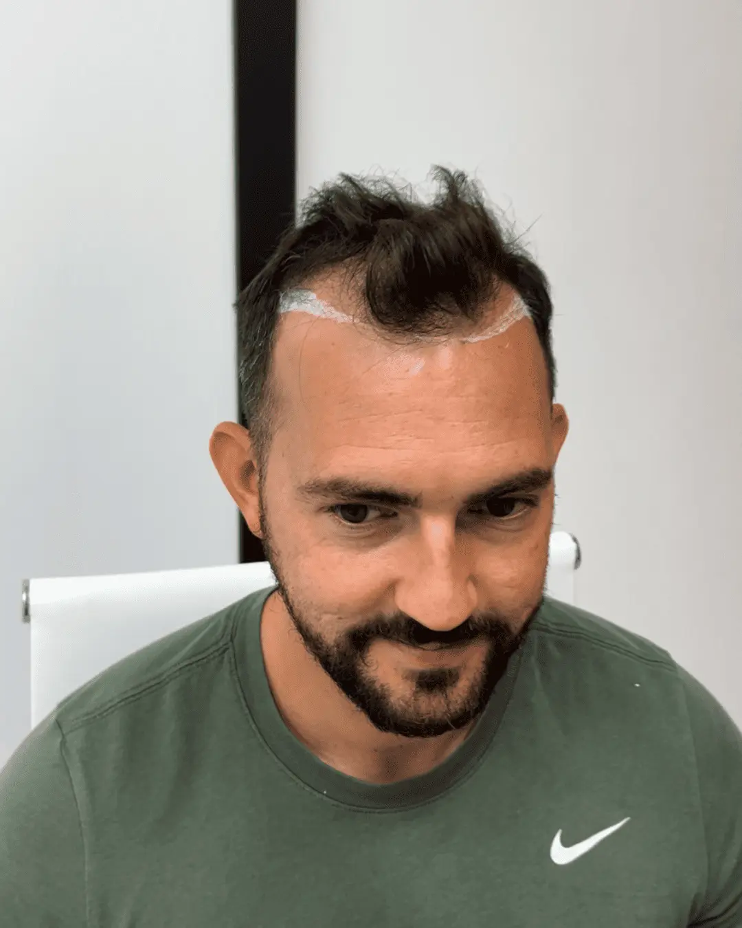 hair translpant before-5