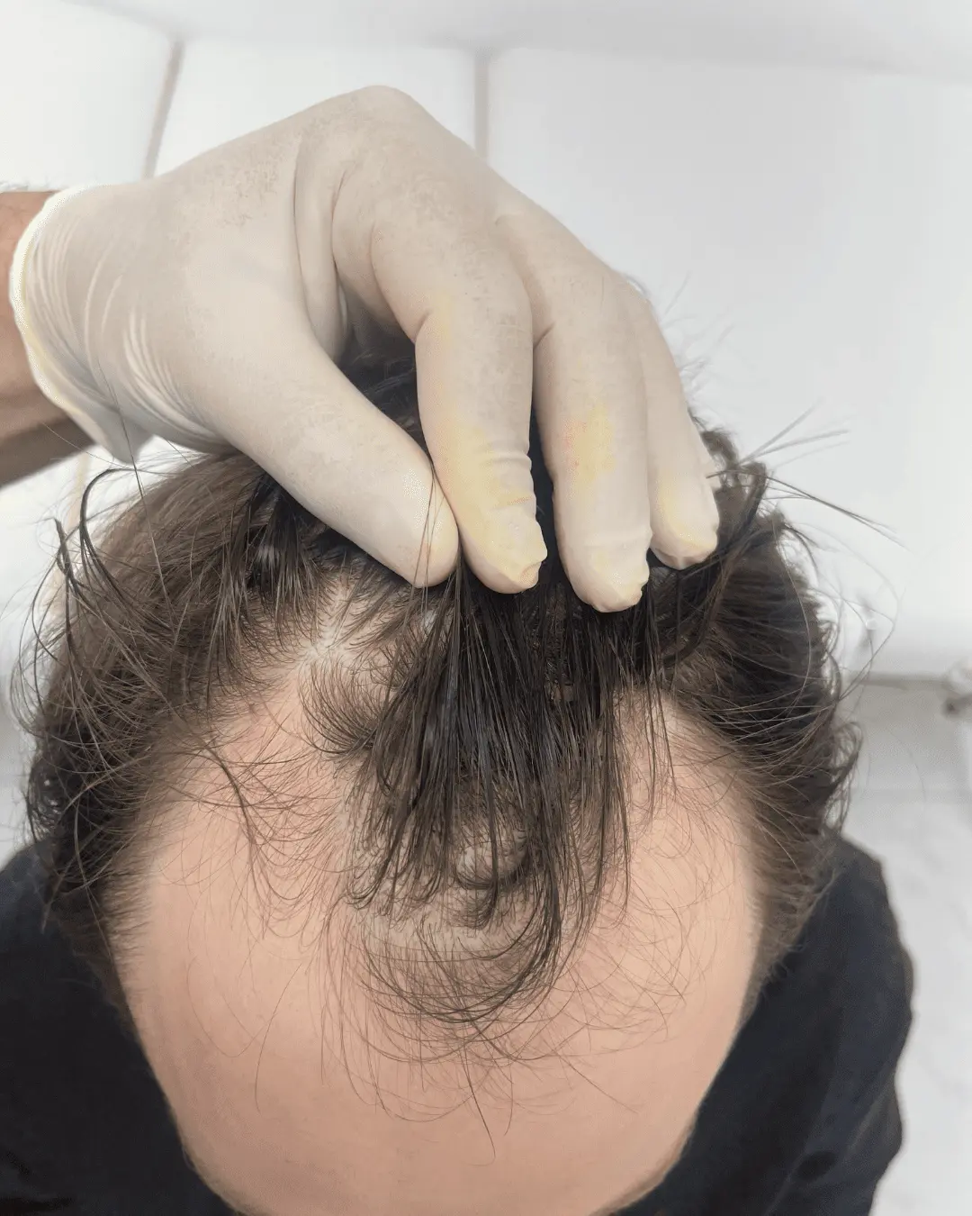 hair translpant before-6