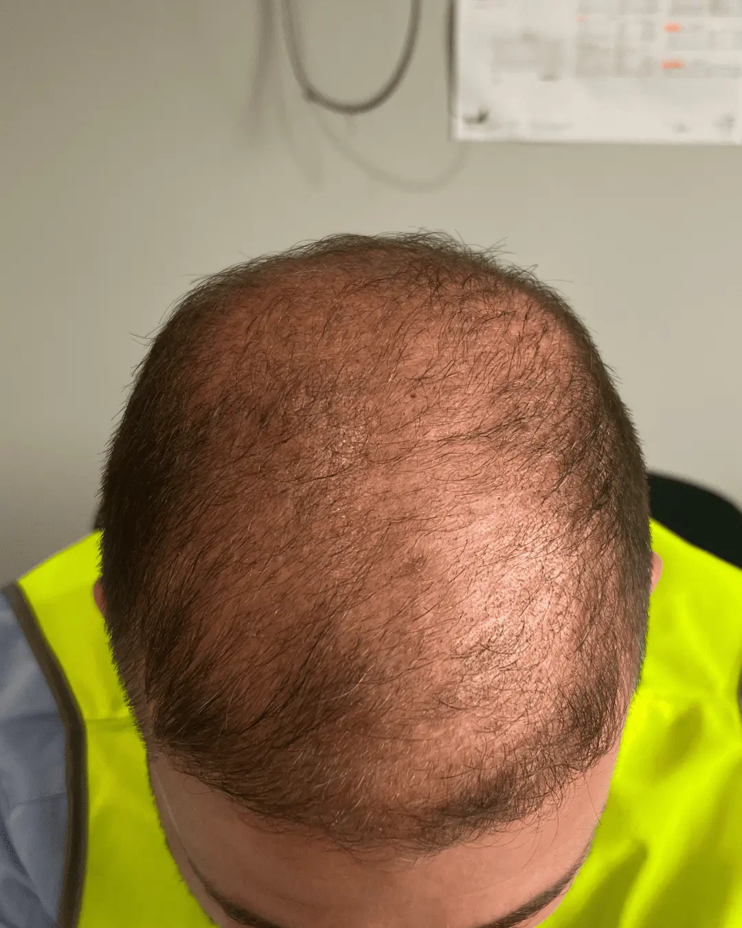 hair translpant before-7