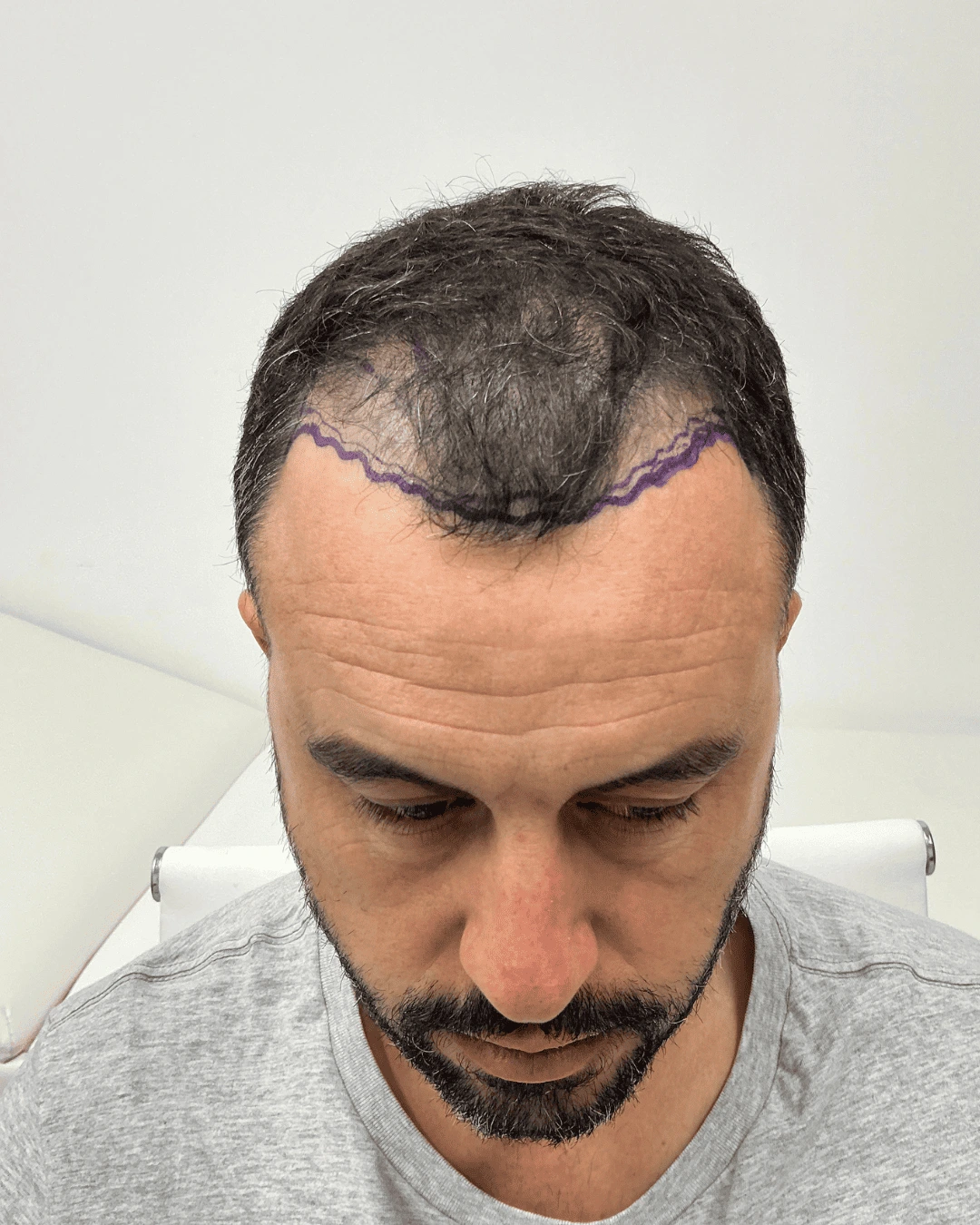 hair translpant before-9