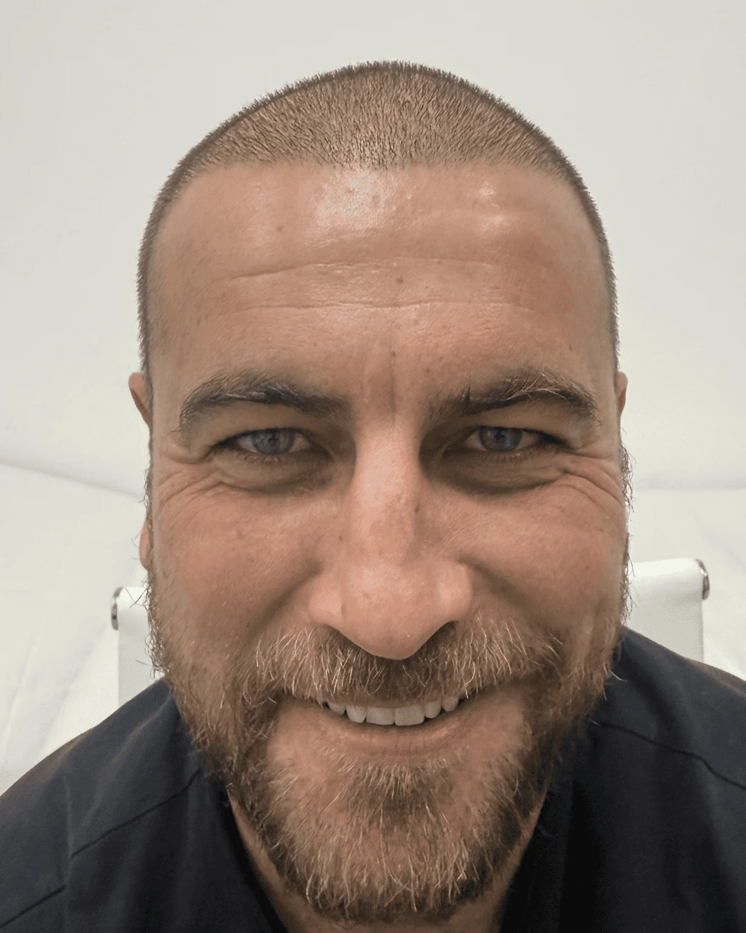 hair transplant after 11