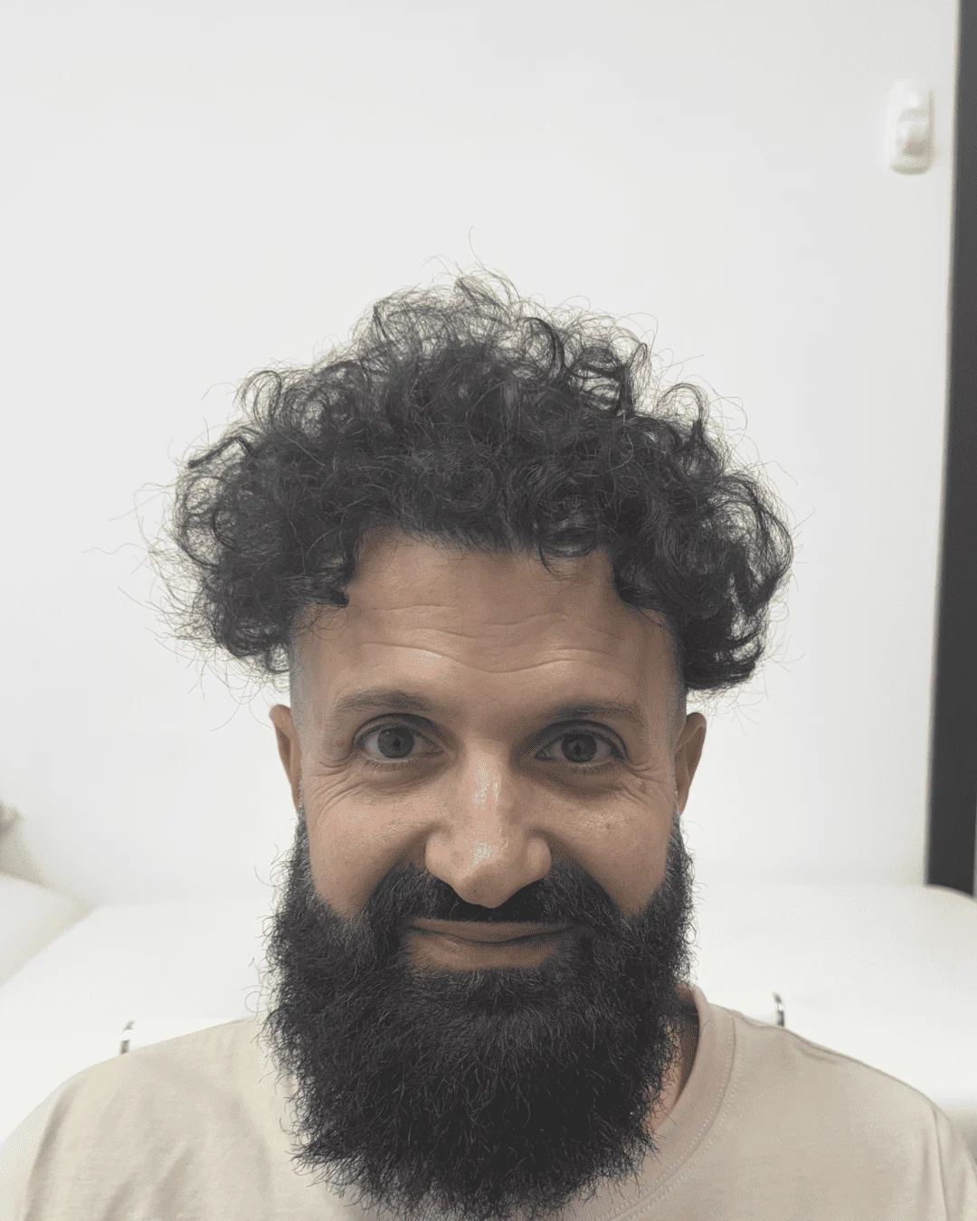 hair transplant after 14