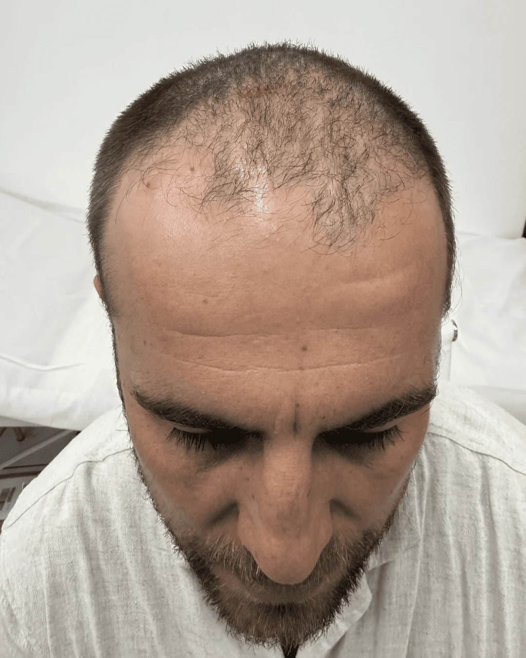 hair transplant before 11