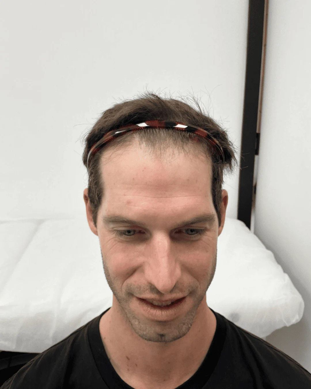 hair transplant before 12