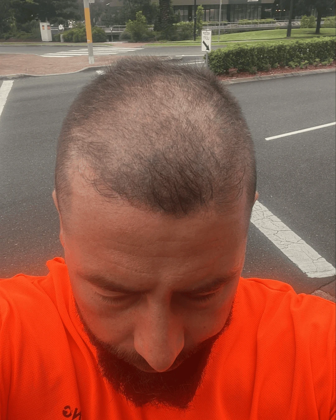 hair transplant before 13