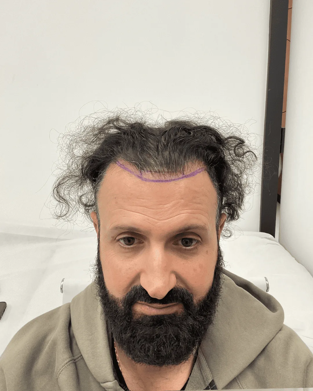 hair transplant before 14