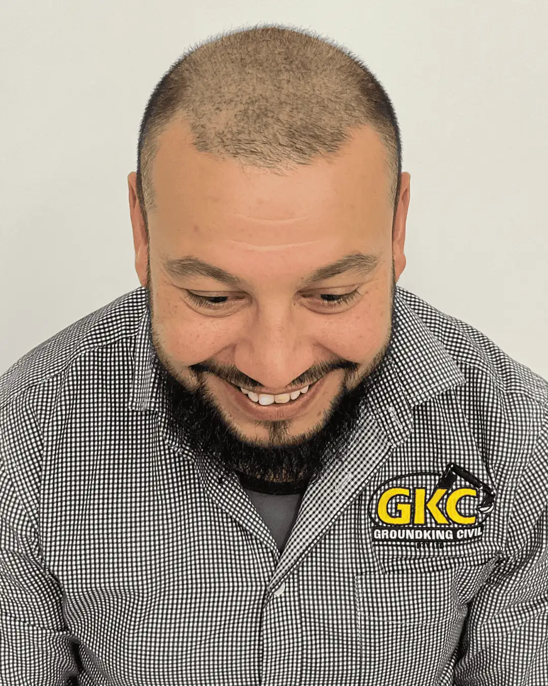 hair transplant before 15