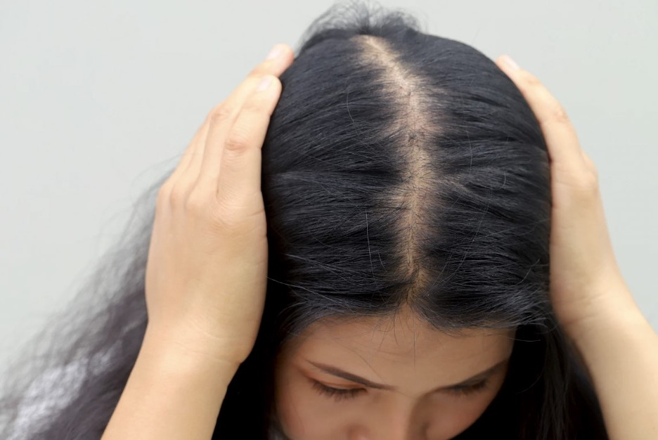 Christmas Tree Pattern Hair Loss & Hair Transplant in Australia Cost: What You Need to Know