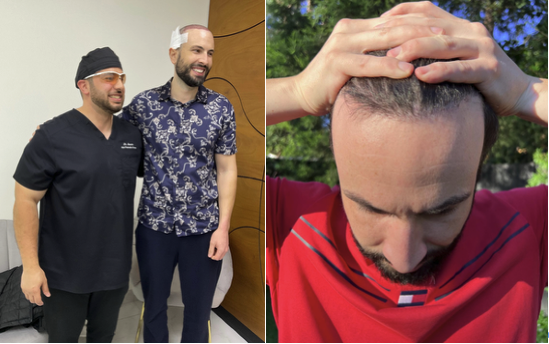 Hair transplant results