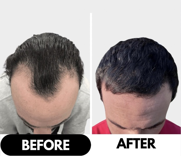 Hair Transplant Before and After Results:  What to Expect and How to Provide the  Best Surgical Aftercare