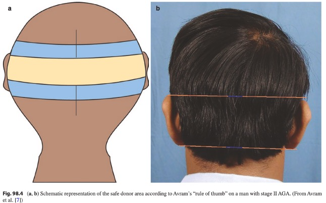 Understanding Your Donor Area in Hair Transplant Surgery